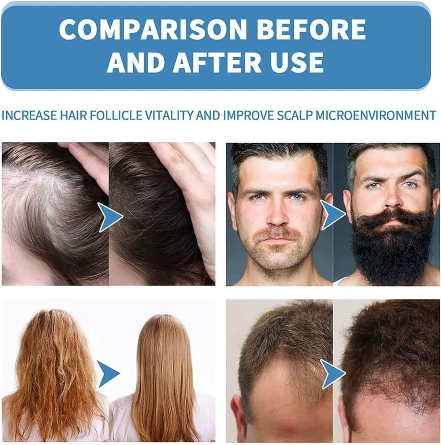 Minoxi Roll-On Hair Treatment Hair Growth Serum For Women & Men (Pack of 2) mkp0fp-jd