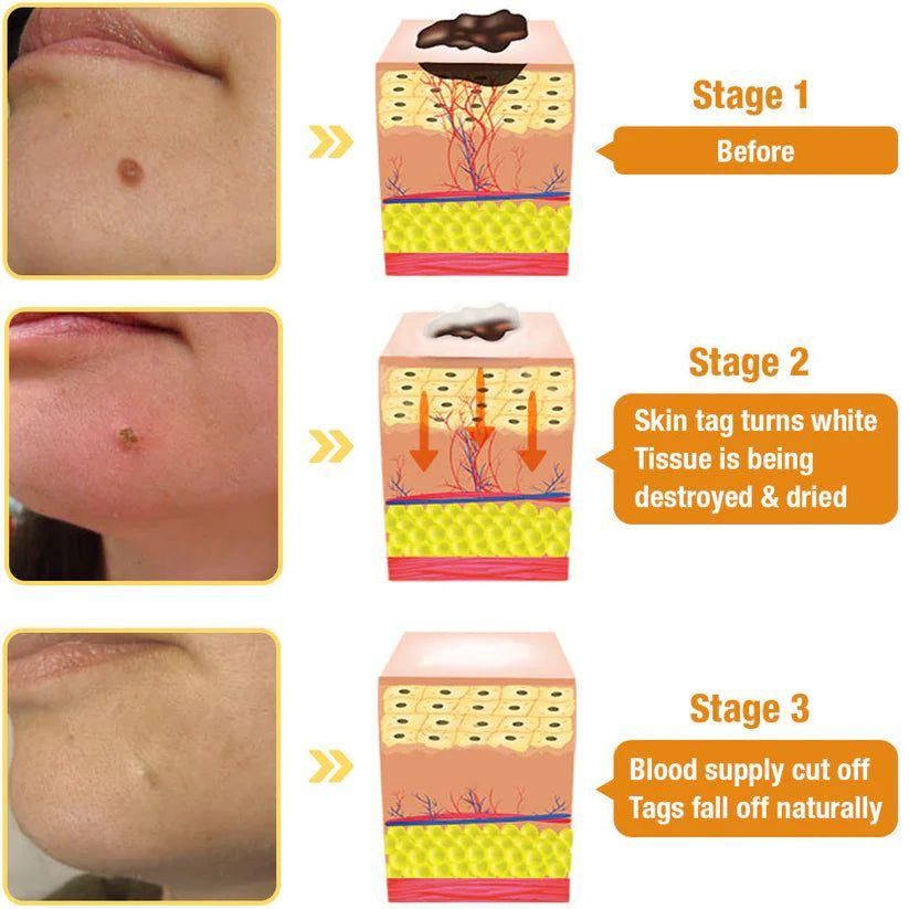 Bee Venom Wart Remover Spray 30ml mkp0fp-jd