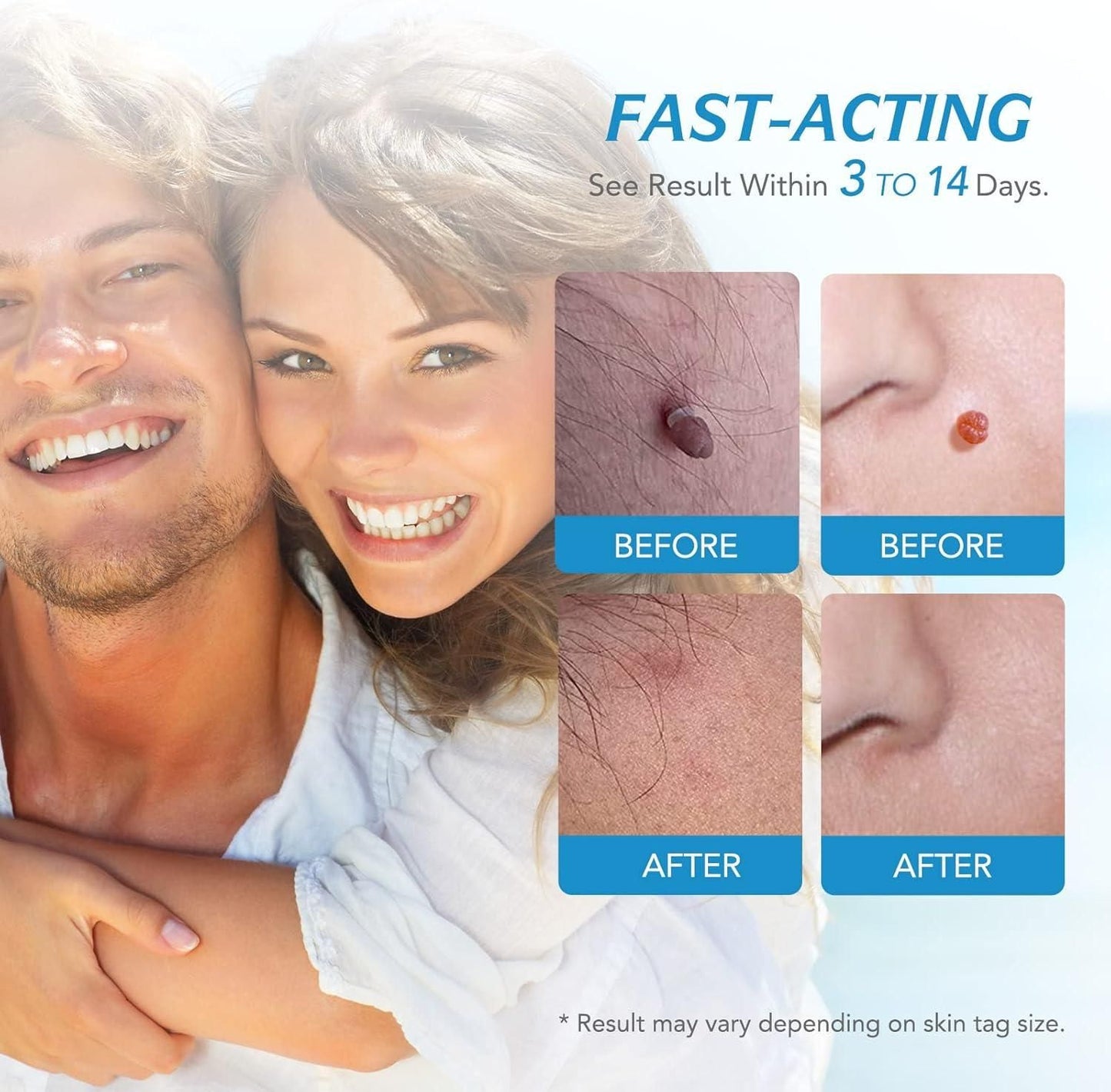2 in 1 Skin Tag Remover Kit - Painless mkp0fp-jd