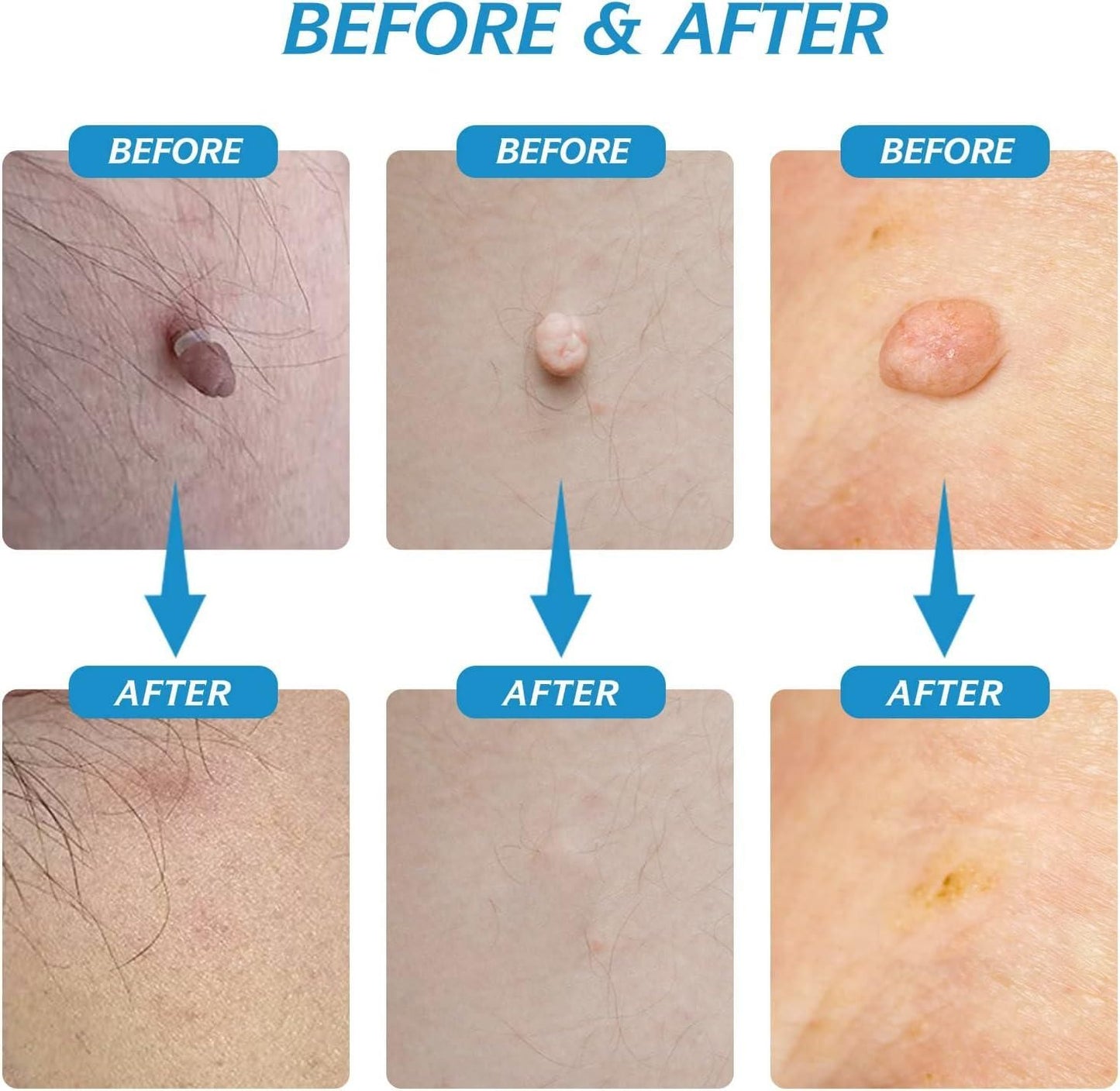 2 in 1 Skin Tag Remover Kit - Painless mkp0fp-jd