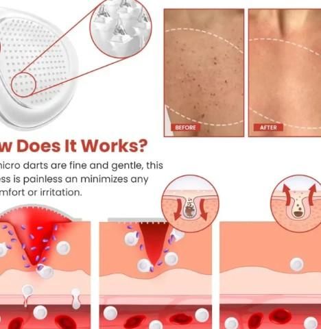 Skin Tag Remover Patch mkp0fp-jd