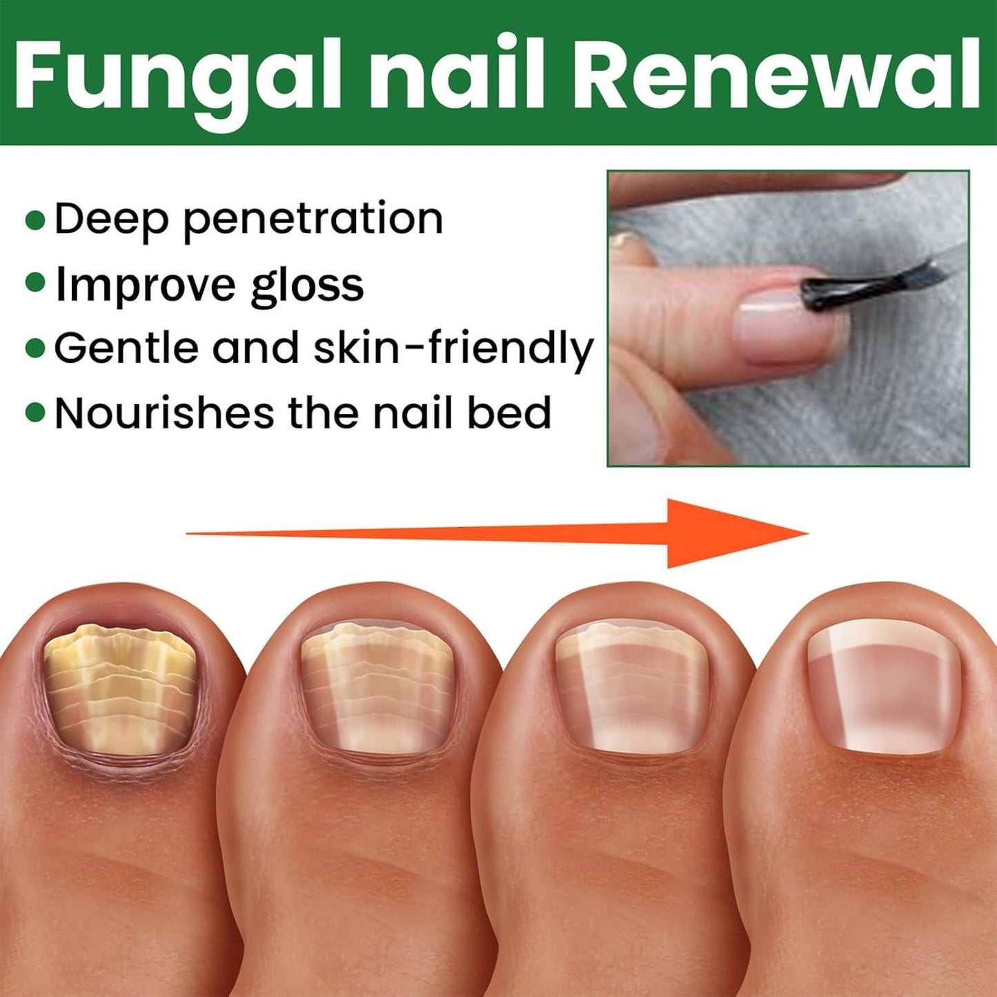Fungal Nail Renewal 30Ml (Pack of 2) mkp0fp-jd
