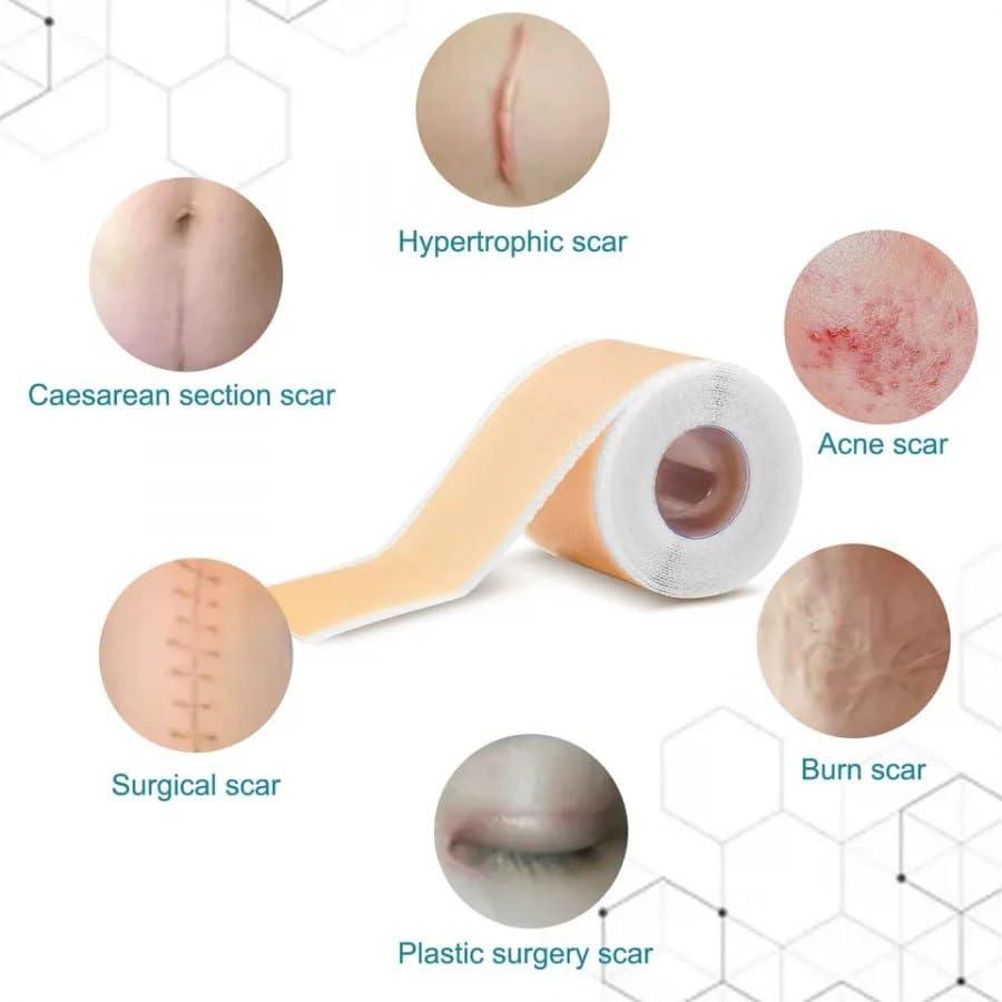 Silicone Scar Sheets, Silicon gel sheets for Scars Transparent Medical Silicone Gel Tape mkp0fp-jd