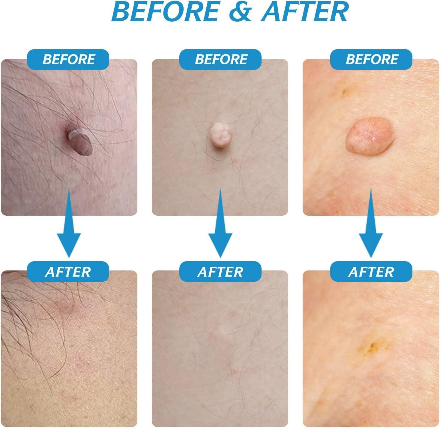2 in 1 Skin Tag Remover Kit - Painless mkp0fp-jd