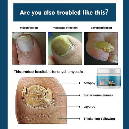 TryOnes Nail Fungus Ointment 100gram (Pack of 2) mkp0fp-jd