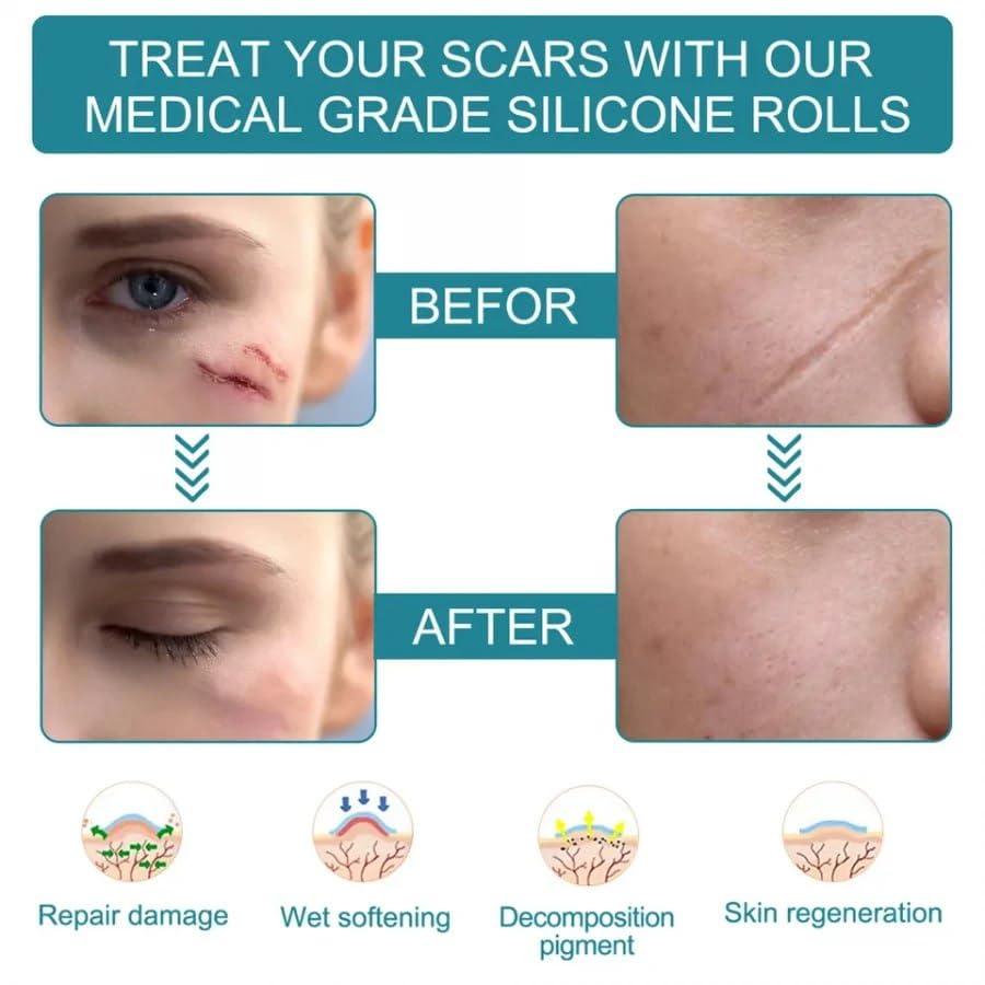 Silicone Scar Sheets, Silicon gel sheets for Scars Transparent Medical Silicone Gel Tape mkp0fp-jd